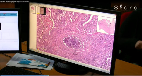 pc che mostra un'ecografia mammaria